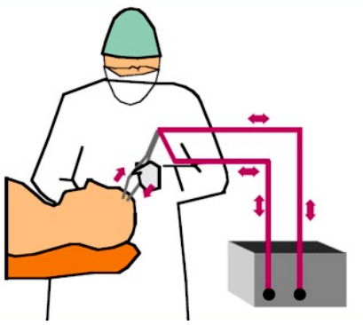 双相性心衰手术示意图 双相性心衰手术示意图